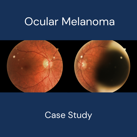 Ocular Melanoma Case Study