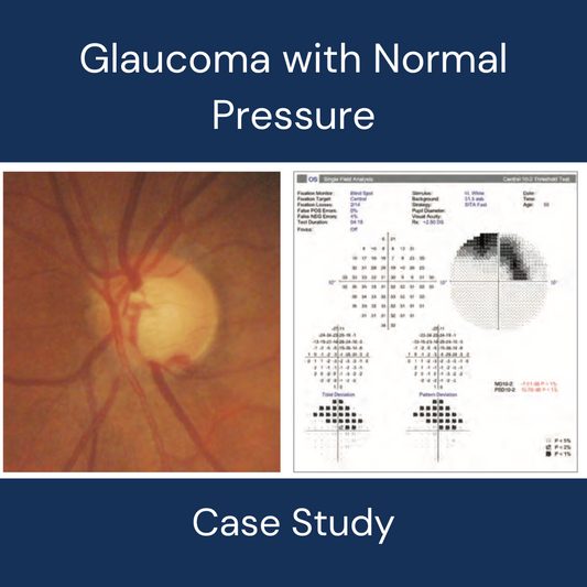 Treating Normal Tension Glaucoma